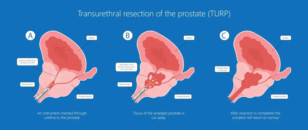 Ilustracja pokazuje etapy elektroresekcji prostaty (TURP), gdzie nadmiar tkanki jest usuwany przez cewkę moczową, przywracając prawidłowy przepływ moczu.