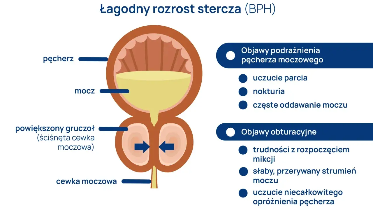 Ilustracja BPH: powiększony gruczoł uciska cewkę, powodując trudności z mikcją i niskie ciśnienie moczu u mężczyzn.