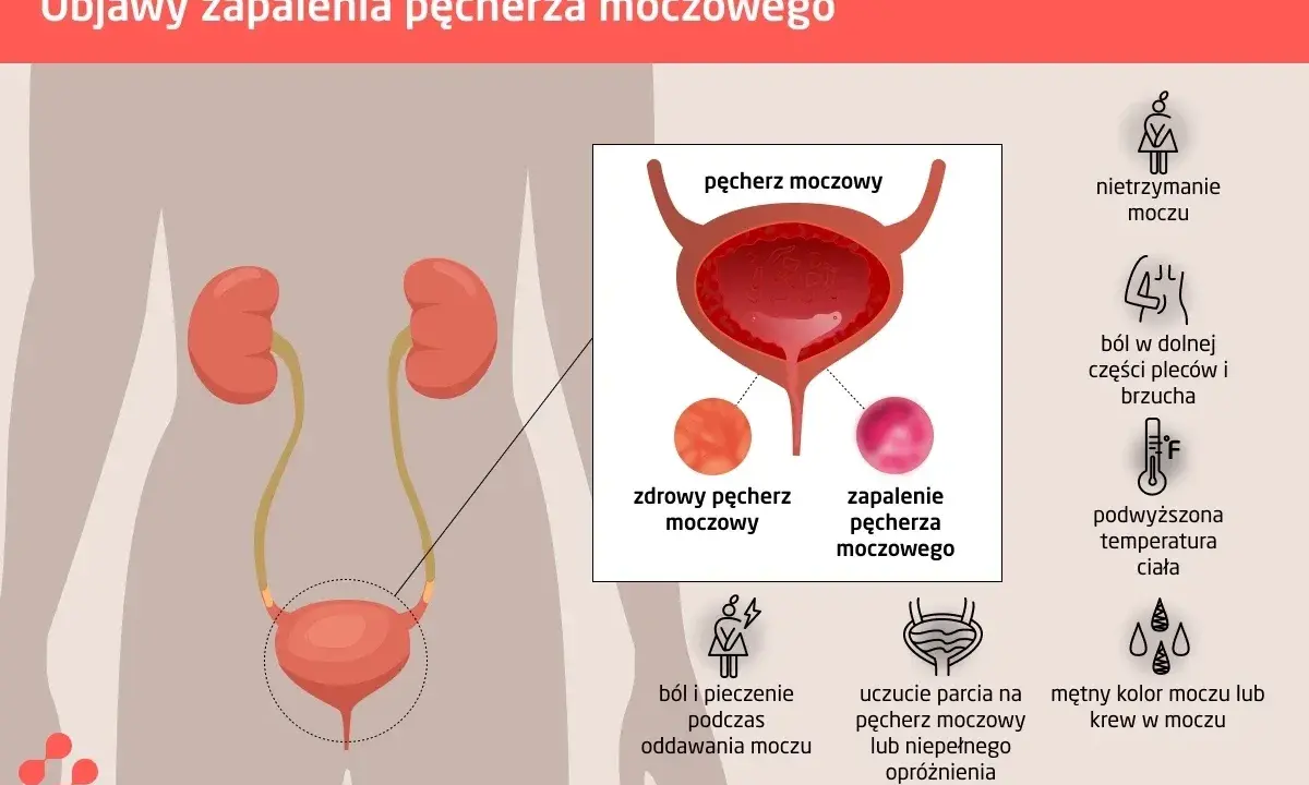 Objawy zapalenia pęcherza: nietrzymanie moczu, ból, pieczenie, uczucie parcia, mętny mocz. Zastój moczu może być objawem.