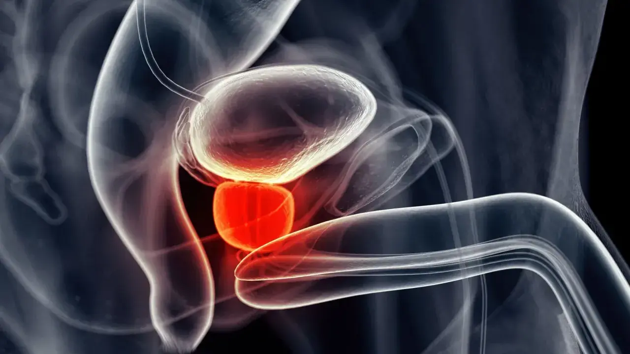 Anatomical illustration showing the bladder and prostate. The third lobe of the prostate is highlighted in red, indicating potential inflammation or abnormality.