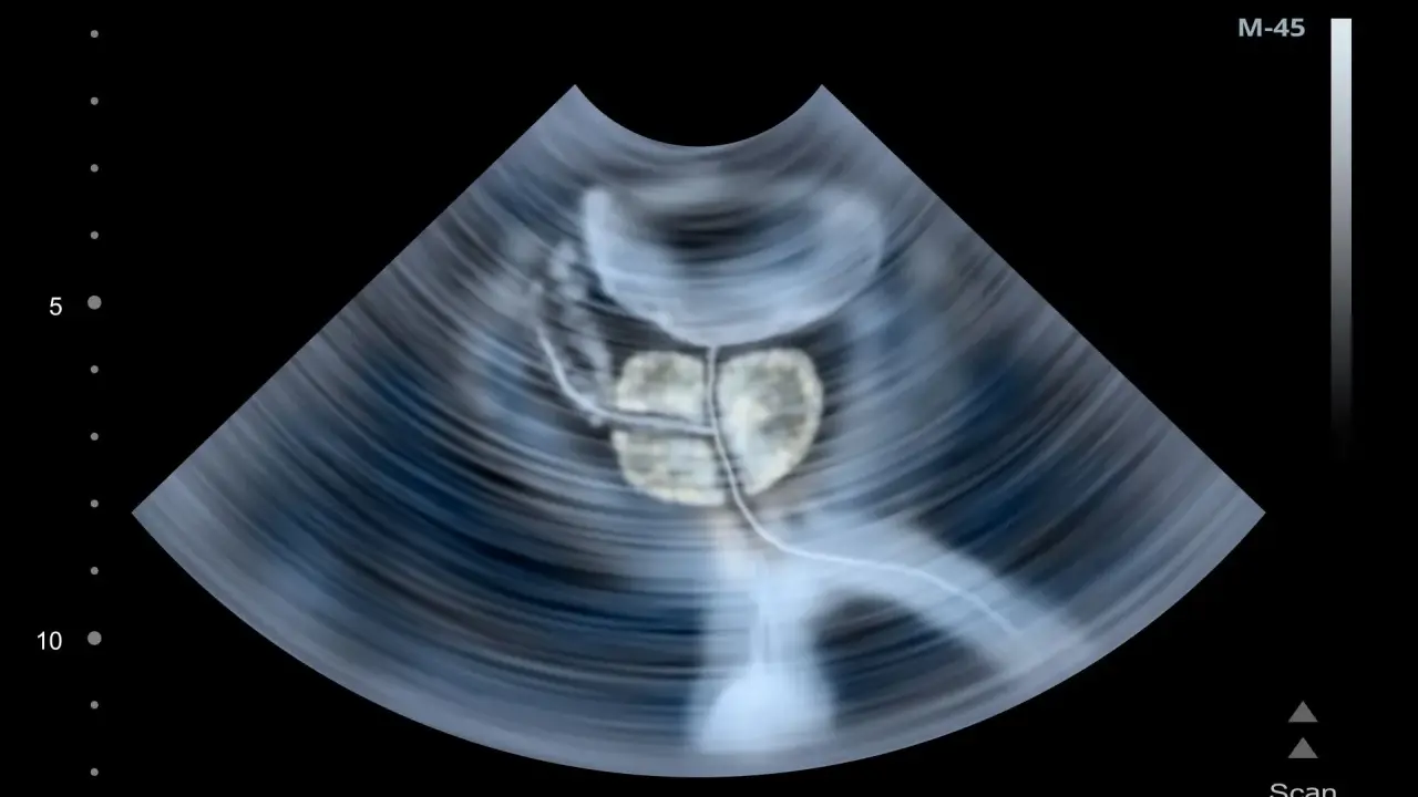 USG prostaty. Częste oddawanie moczu po operacji prostaty może być związane z różnymi czynnikami, które lekarz oceni.