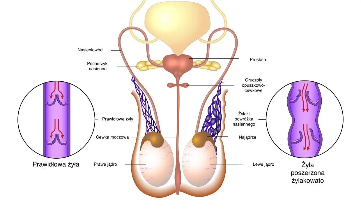 Anatomia jąder z widocznymi żyłami powrózka nasiennego. Po prawej stronie widok poszerzonej żyły, co może być jednym z objawów zapalenia jądra u dziecka.