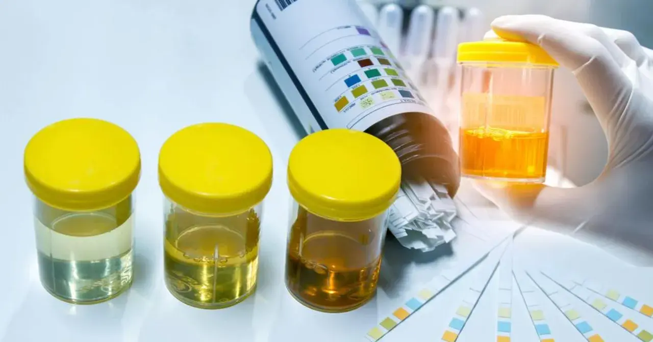 Analiza próbek moczu i pasków testowych. Zastanawiasz się, co oznacza ślad krwi w moczu? To może być sygnał do dalszej diagnostyki.