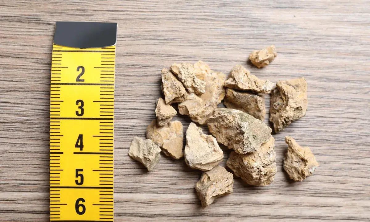 Miarka obok kamieni nerkowych pokazuje, jak długo rośnie kamień w nerce. Kamienie mają od 2 do 6 cm.