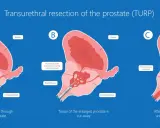 Ilustracja pokazuje etapy elektroresekcji prostaty (TURP), gdzie nadmiar tkanki jest usuwany przez cewkę moczową, przywracając prawidłowy przepływ moczu.