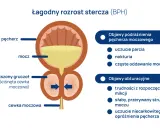 Ilustracja BPH: powiększony gruczoł uciska cewkę, powodując trudności z mikcją i niskie ciśnienie moczu u mężczyzn.