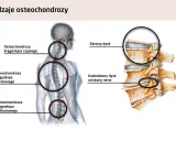 Czy ból jąder może być od kręgosłupa? Ilustracja pokazuje osteochondrozę kręgosłupa szyjnego, piersiowego i lędźwiowego, a także uszkodzony dysk uciskający nerw.
