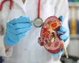 Lekarz w niebieskich rękawiczkach pokazuje model nerki z widocznym ureterocele, wskazując na niebieski element.