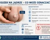 Powiększone i twarde jądro z wyczuwalnym guzem. Obraz przedstawia powiększone jądro z widocznym guzem, podkreślając potrzebę konsultacji urologicznej.