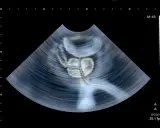USG prostaty. Częste oddawanie moczu po operacji prostaty może być związane z różnymi czynnikami, które lekarz oceni.