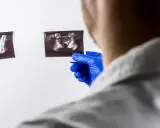 Lekarz w niebieskich rękawiczkach analizuje dwa zdjęcia USG, szukając odpowiedzi na pytanie: rak prostaty ile się żyje.
