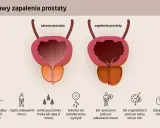 Ilustracja porównuje zdrową prostatę z zapaloną, pokazując objawy zapalenia prostaty: słaby strumień moczu, ból, pieczenie i zaburzenia erekcji.