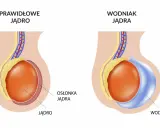 Porównanie prawidłowego jądra z wodniakiem jądra, który może pojawić się po operacji przepukliny pachwinowej.