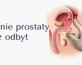 Ilustracja przedstawia badanie per rectum. Palec w rękawiczce bada prostatę, która może być wyczuwalna jako twarda.
