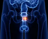 Anatomical rendering of the male pelvic region, highlighting the prostate with a glowing red area indicating a potential issue. Pytanie: czy prostatę można wyleczyć?