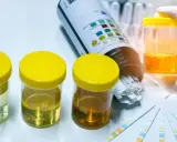 Analiza próbek moczu i pasków testowych. Zastanawiasz się, co oznacza ślad krwi w moczu? To może być sygnał do dalszej diagnostyki.