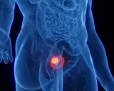 Widok anatomiczny ukazujący polip w pęcherzu moczowym, zaznaczony kolorem pomarańczowym i czerwonym.