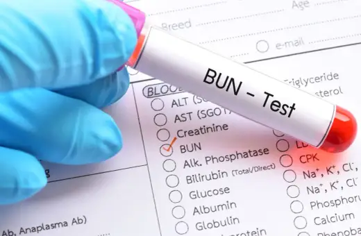 Rękawiczka w niebieskiej rękawiczce trzyma probówkę z napisem "BUN - Test". Zaznaczono pole "BUN", co może wskazywać na badanie w kierunku zatrucia mocznikiem objawy.