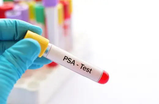 Ręka w niebieskiej rękawiczce trzyma probówkę z napisem "PSA - Test". Wynik badania PSA całkowitego jest kluczowy.