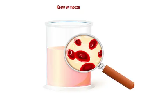 Szkło powiększające pokazuje czerwone krwinki w próbce moczu, ilustrując krwiomocz i krwinkomocz.