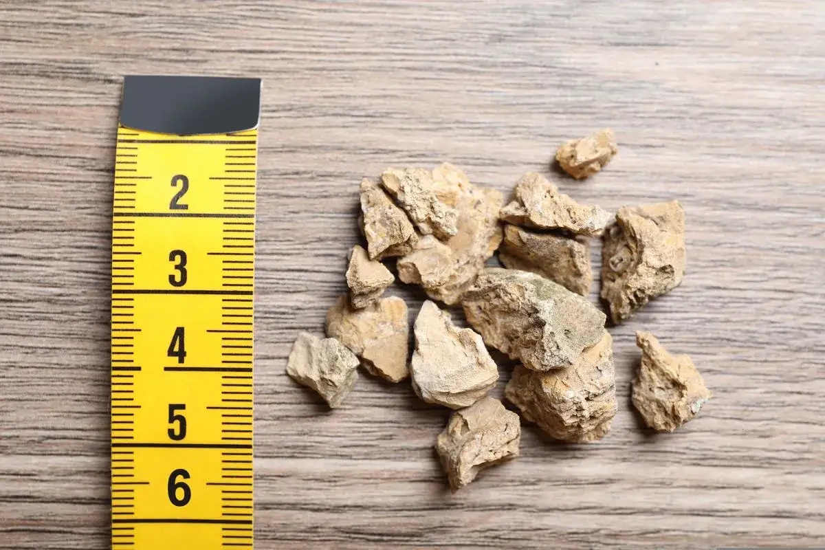 Miarka obok kamieni nerkowych pokazuje, jak długo rośnie kamień w nerce. Kamienie mają od 2 do 6 cm.