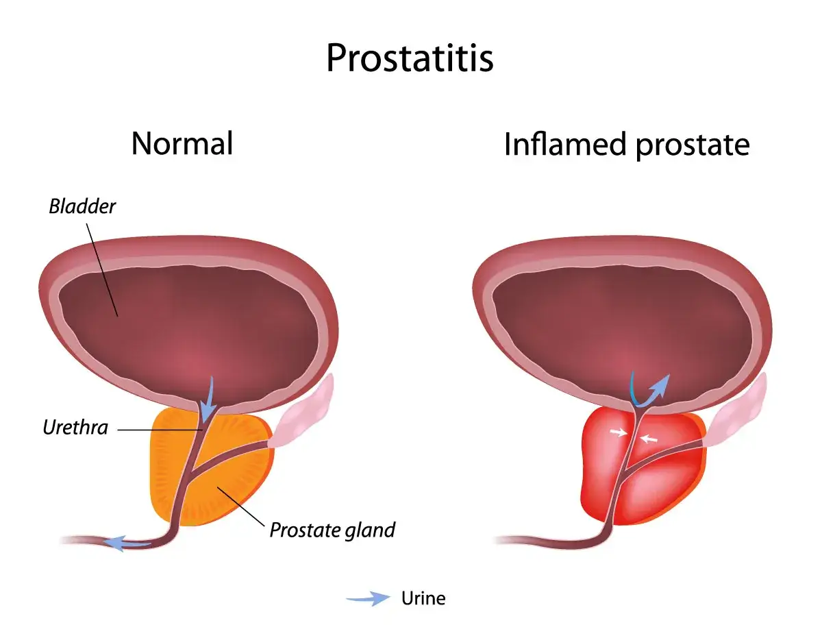 Porównanie prawidłowej i zapalnej prostaty. Zapalenie prostaty może powodować ból.