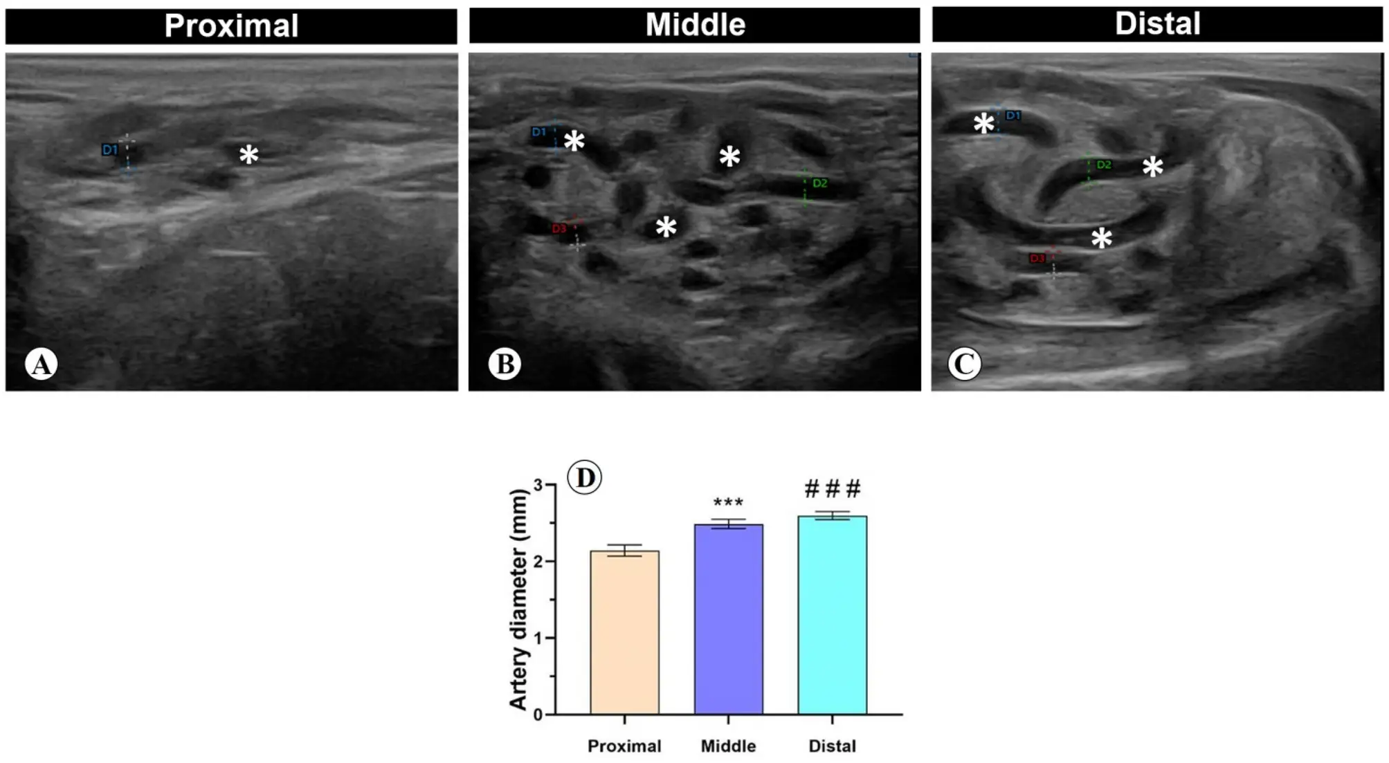 Ultrasonografia jąder: obraz A (proksymalny), B (środkowy), C (dystalny) z zaznaczonymi średnicami naczyń. D: wykres porównujący średnicę tętnicy w różnych odcinkach, wskazujący na potencjalne choroby jąder.