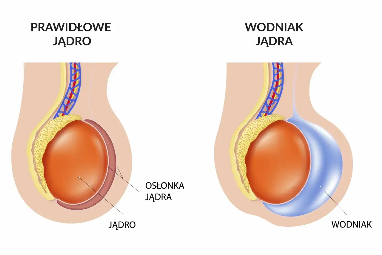 Porównanie prawidłowego jądra z wodniakiem jądra. Wodniaki jądra mogą wymagać leczenia.